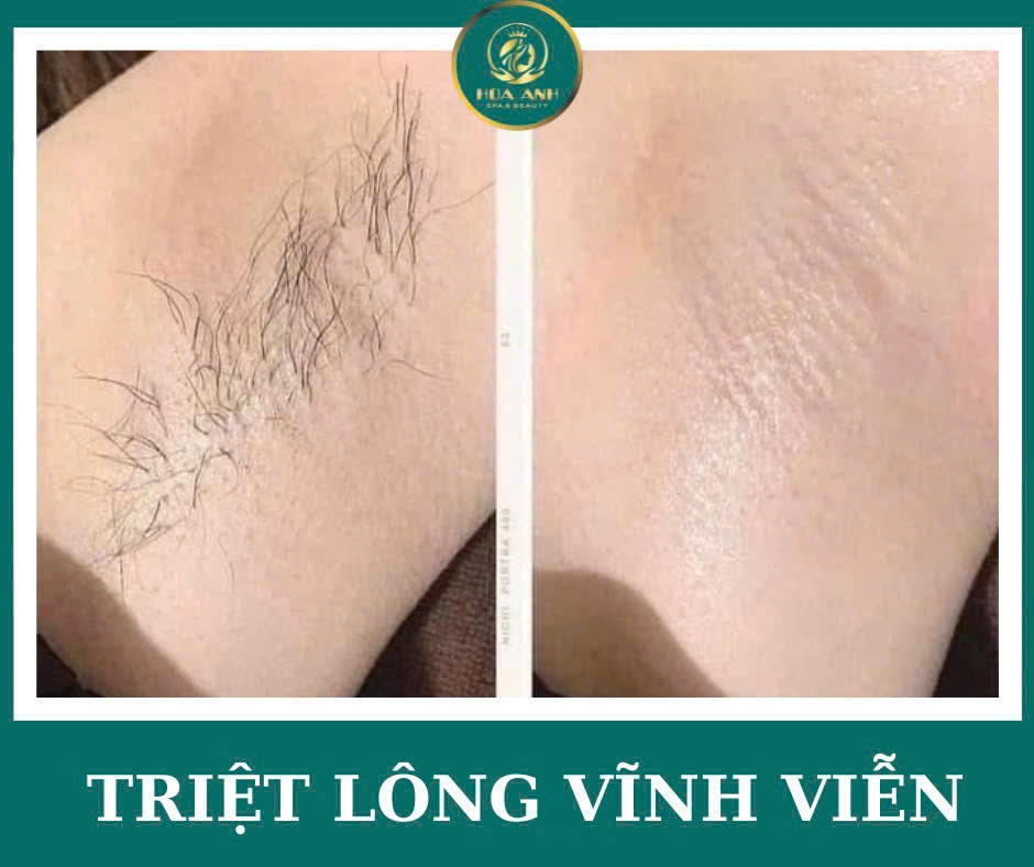 Triệt lông nách nam – Giải pháp chăm sóc bản thân tinh tế cho phái mạnh