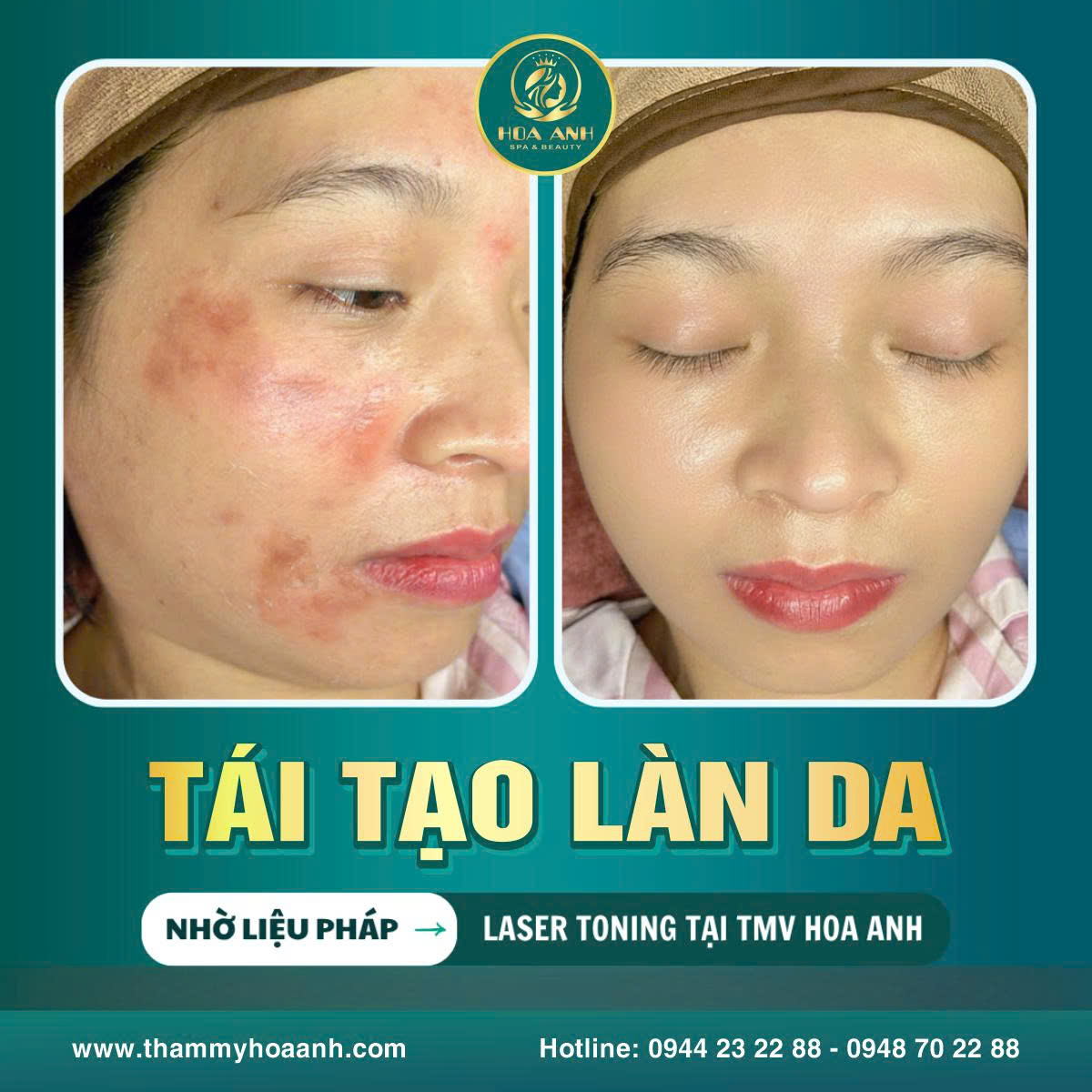 Dịch Vụ Tái Tạo Da Chuyên Sâu Tại Thẩm Mỹ Viện Hoa Anh Rạch Giá – Giải Pháp Trẻ Hóa Làn Da An Toàn, Hiệu Quả