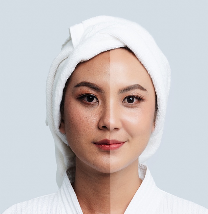 DƯỠNG TRẮNG DA  - HIỆU QUẢ SAU 1 LIỆU TRÌNH