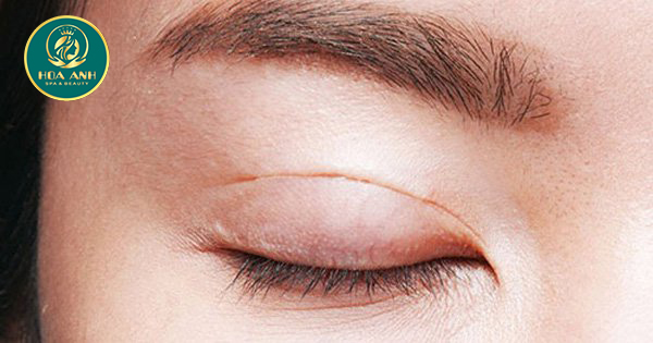 Sau khi cắt chỉ mí mắt có bôi thuốc mỡ không?