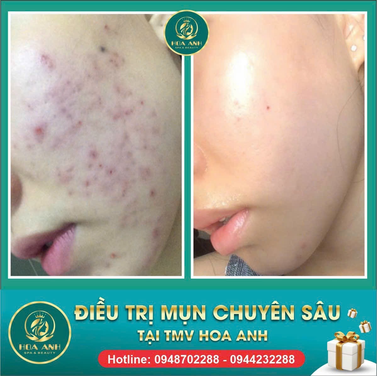 Hành Trình Điều Trị Mụn Khi Da Bị Nhiễm Corticoid: Kinh Nghiệm Và Lời Khuyên Thực Tế