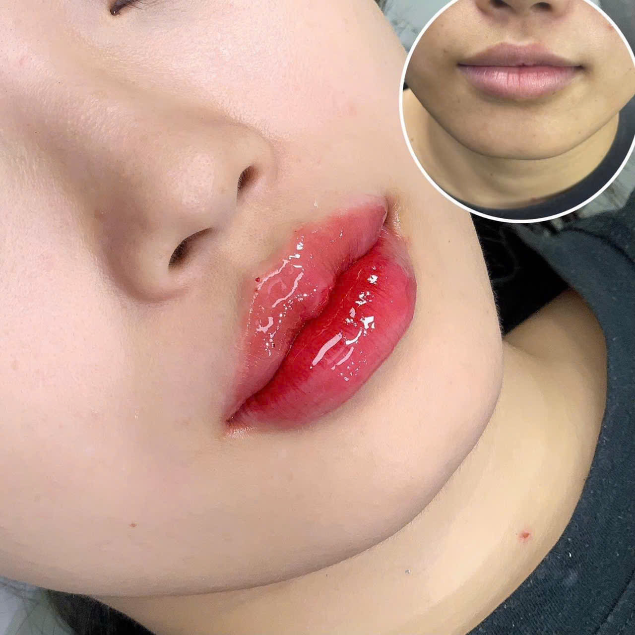 Tiêm Filler Môi Tại Thẩm Mỹ Viện Hoa Anh – Chạm Nhẹ Để Đôi Môi Kể Câu Chuyện Đẹp Của Riêng Bạn