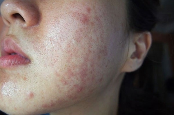 Tác hại của kem kết hợp chứa corticosteroid và những điều bạn cần biết