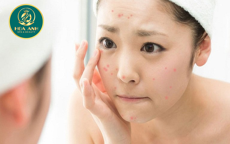 Cách làm mặt nạ trị mụn tại nhà