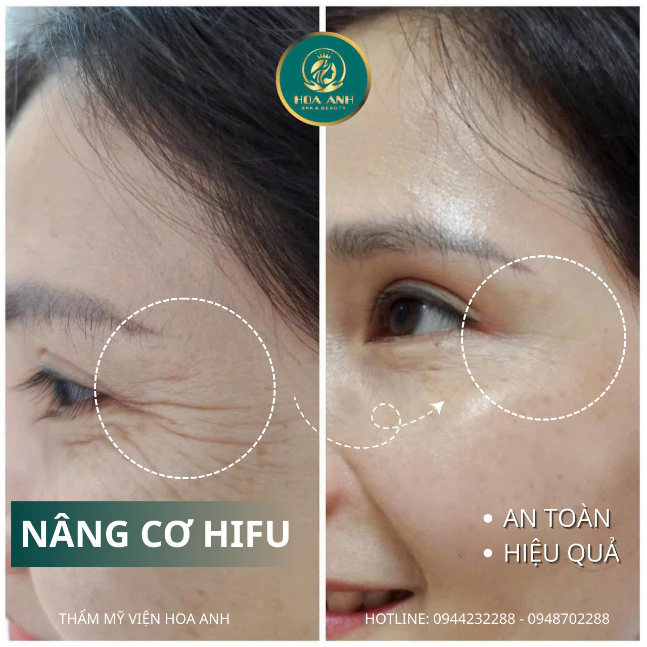 Nâng Cơ Xóa Nhăn Công Nghệ HIFU – Giải Pháp Trẻ Hóa Da Hiện Đại Tại Thẩm Mỹ Viện Hoa Anh