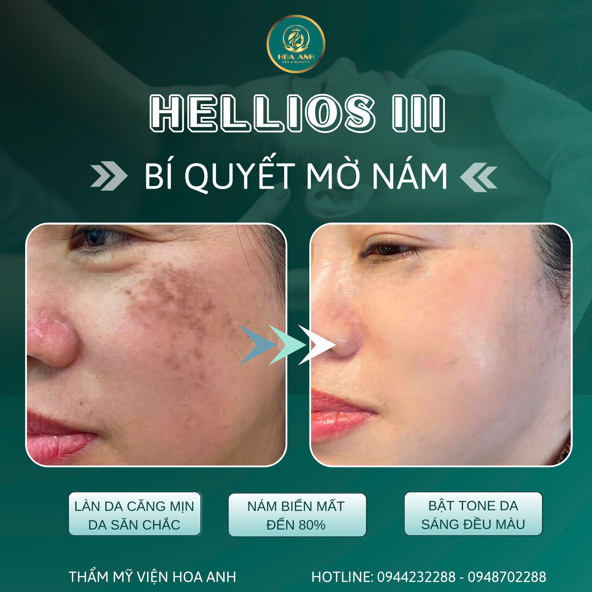 Điều trị nám – Hành trình lấy lại làn da trắng sáng, rạng rỡ đón Tết tại Thẩm mỹ viện Hoa Anh