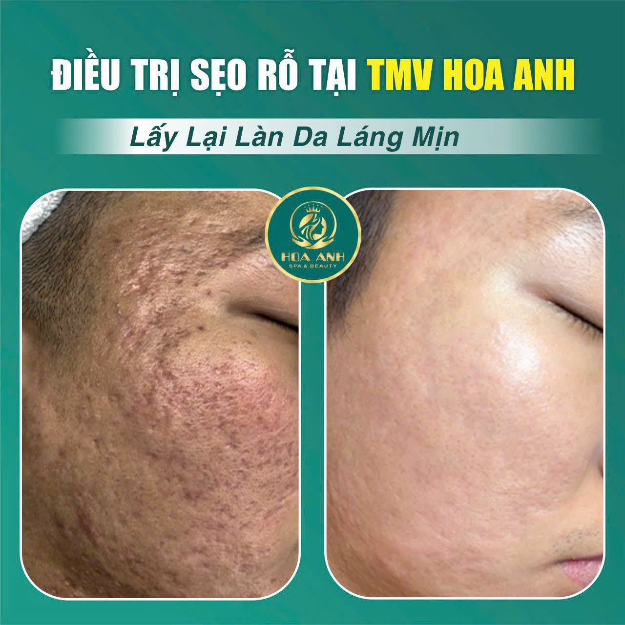Sẹo Rỗ: Nguyên Nhân, Phân Loại, Và Phác Đồ Điều Trị Hiệu Quả Nhất Hiện Nay