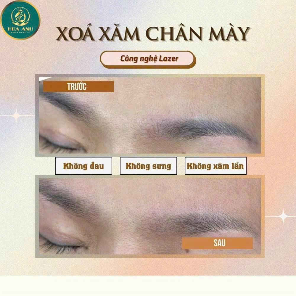 Cách Khắc Phục Mày Trổ Xanh – Trổ Đỏ Nhanh Chóng & An Toàn Tại Thẩm Mỹ Viện Hoa Anh