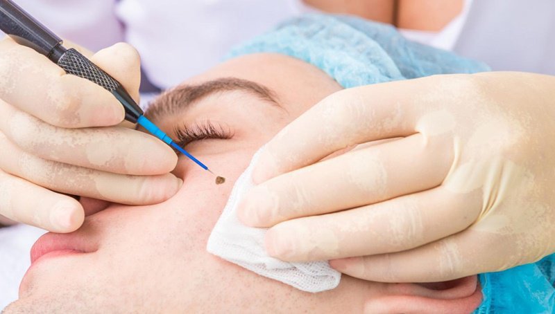 Điều trị sẹo do mụn bằng laser
