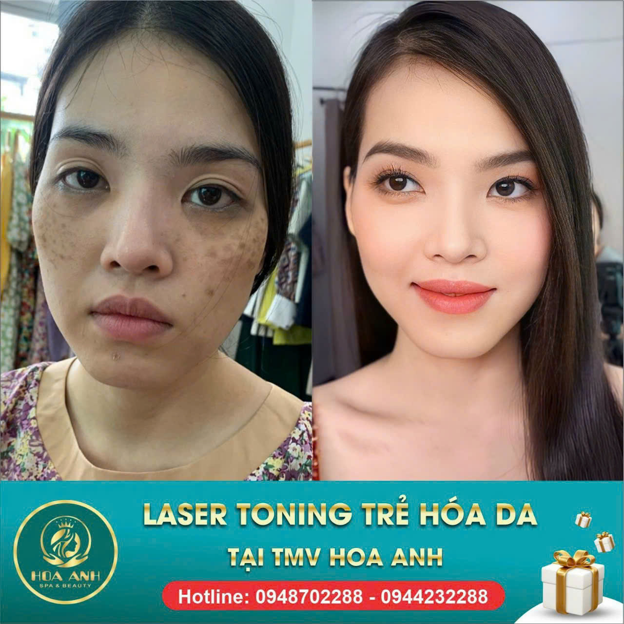 Toning Trẻ Hóa Da Là Gì ?