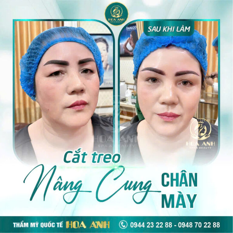 Treo Cung Mày – Giải Pháp Trẻ Hóa Vùng Mắt An Toàn, Hiệu Quả Tại Thẩm Mỹ Viện Hoa Anh