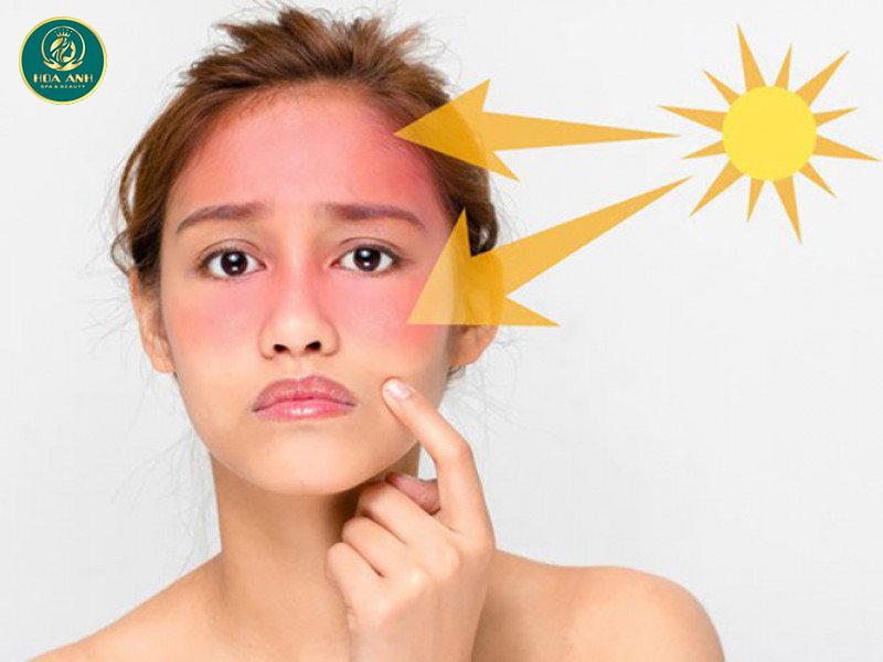 Da mặt bị cháy nắng làm sao để trắng lại?