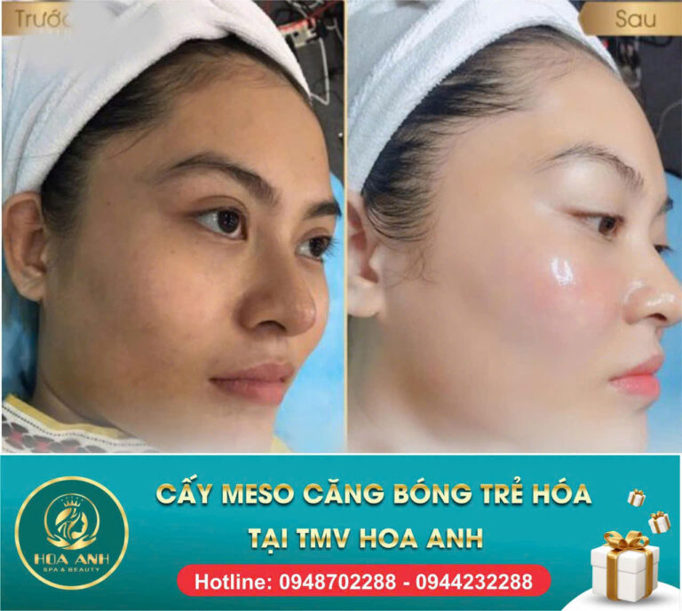 Cấy Meso Căng Bóng Trẻ Hóa Da Và Điều Trị Sạm Nám Bằng Công Nghệ Remi Pro 9 – Giải Pháp Trẻ Hóa Chuẩn Y Khoa Tại Thẩm Mỹ Viện Hoa Anh