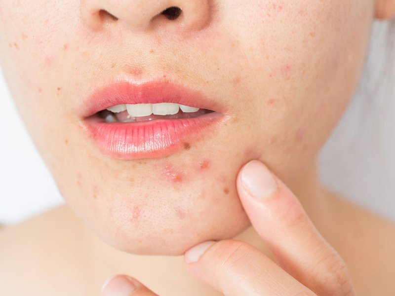 Vitamin A trị mụn trứng cá có tốt không?