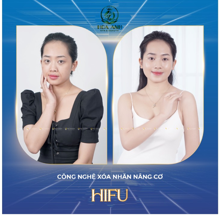 KHOẺ CHUẨN - ĐẸP CÙNG HOA   ANH : GIẢM 65% TẤT CẢ CÁC DỊCH VỤ LÀM ĐẸP