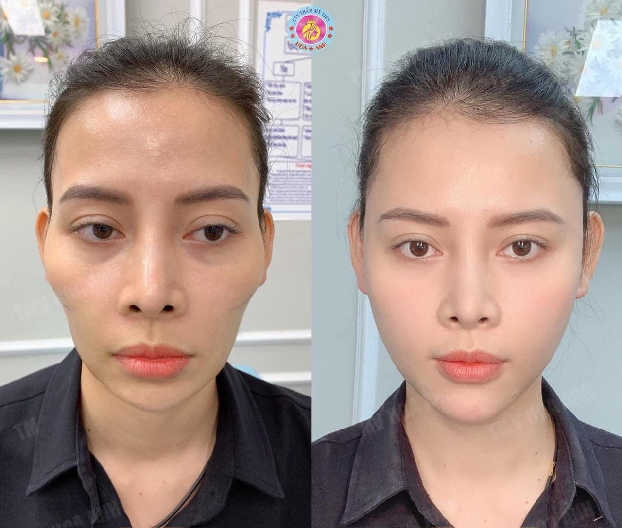 Tiêm Full Face Tại Thẩm Mỹ Viện Hoa Anh Rạch Giá – Giải Pháp Trẻ Hóa Toàn Diện, Đẹp Tự Nhiên