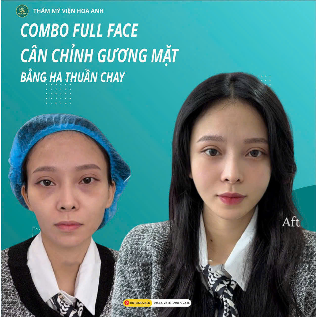 Tiêm Filler Full Face – Giải Pháp Trẻ Hóa Toàn Diện Không Phẫu Thuật Tại Thẩm Mỹ Viện Hoa Anh