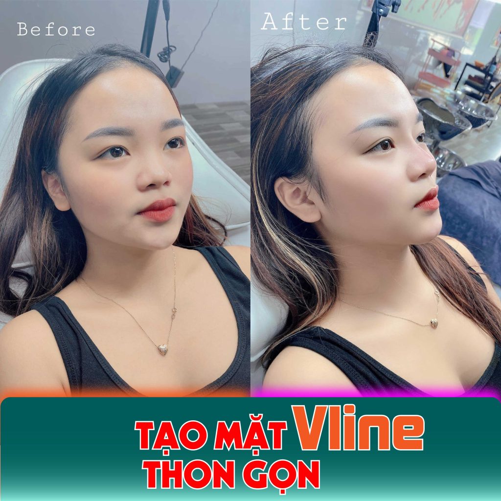 Tiêm botox bao lâu có tác dụng hiệu quả?