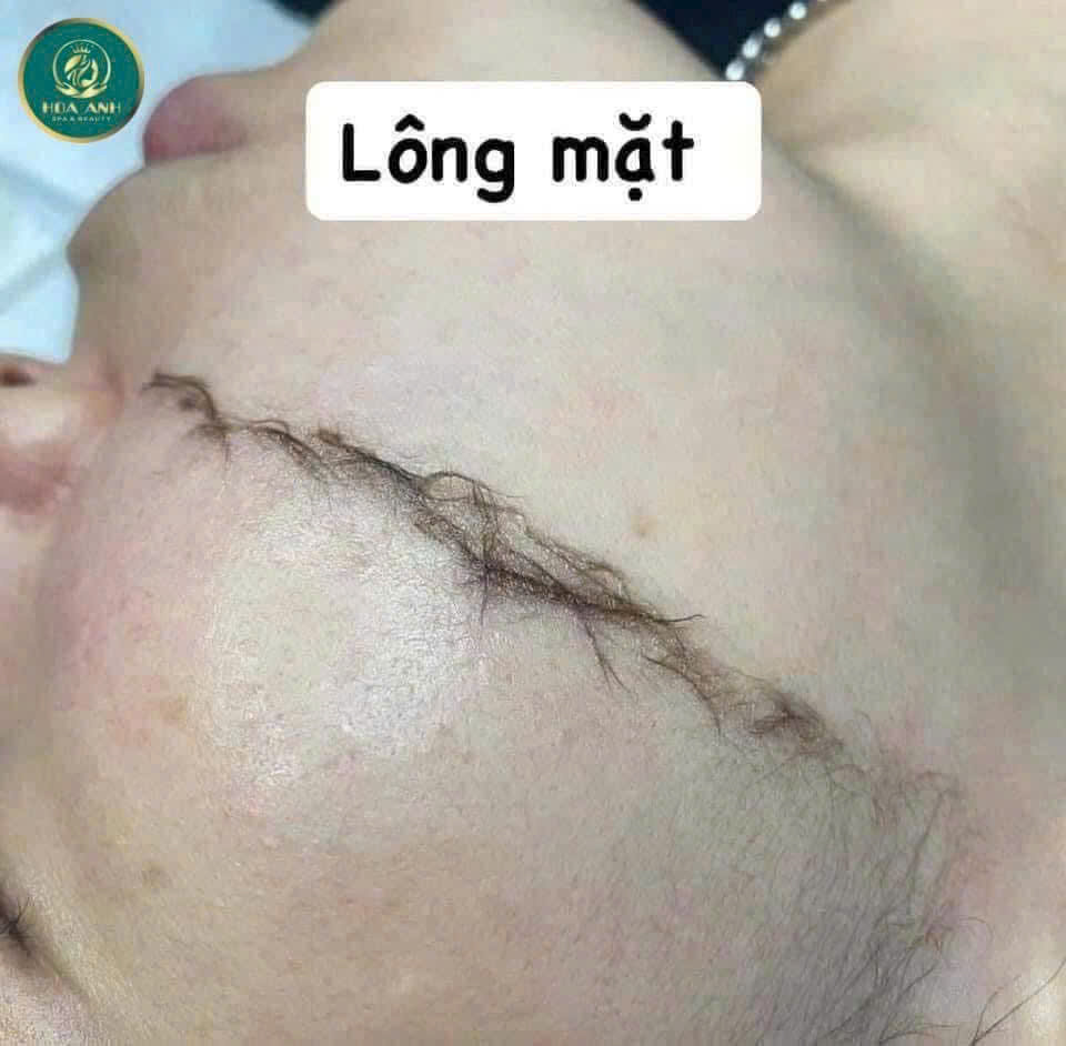 Triệt lông mặt có bị kích ứng da không? Khám phá sự thật từ chuyên gia Thẩm Mỹ Viện Hoa Anh