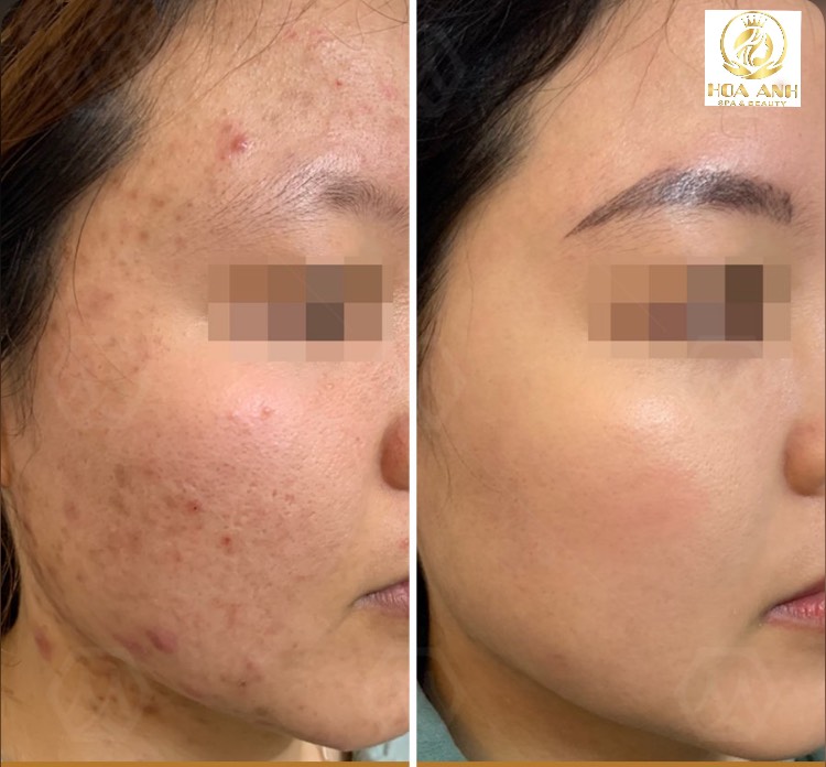 Nặn mụn xong nên làm gì? Chăm sóc da sau nặn mụn đúng cách