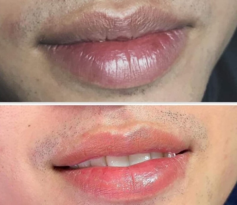 Dịch Vụ Khử Thâm Môi – Giải Pháp Làm Đẹp Tự Nhiên Cho Mọi Đối Tượng