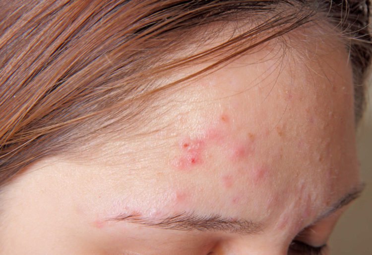 10 phương pháp điều trị mụn trứng cá ở tuổi teen