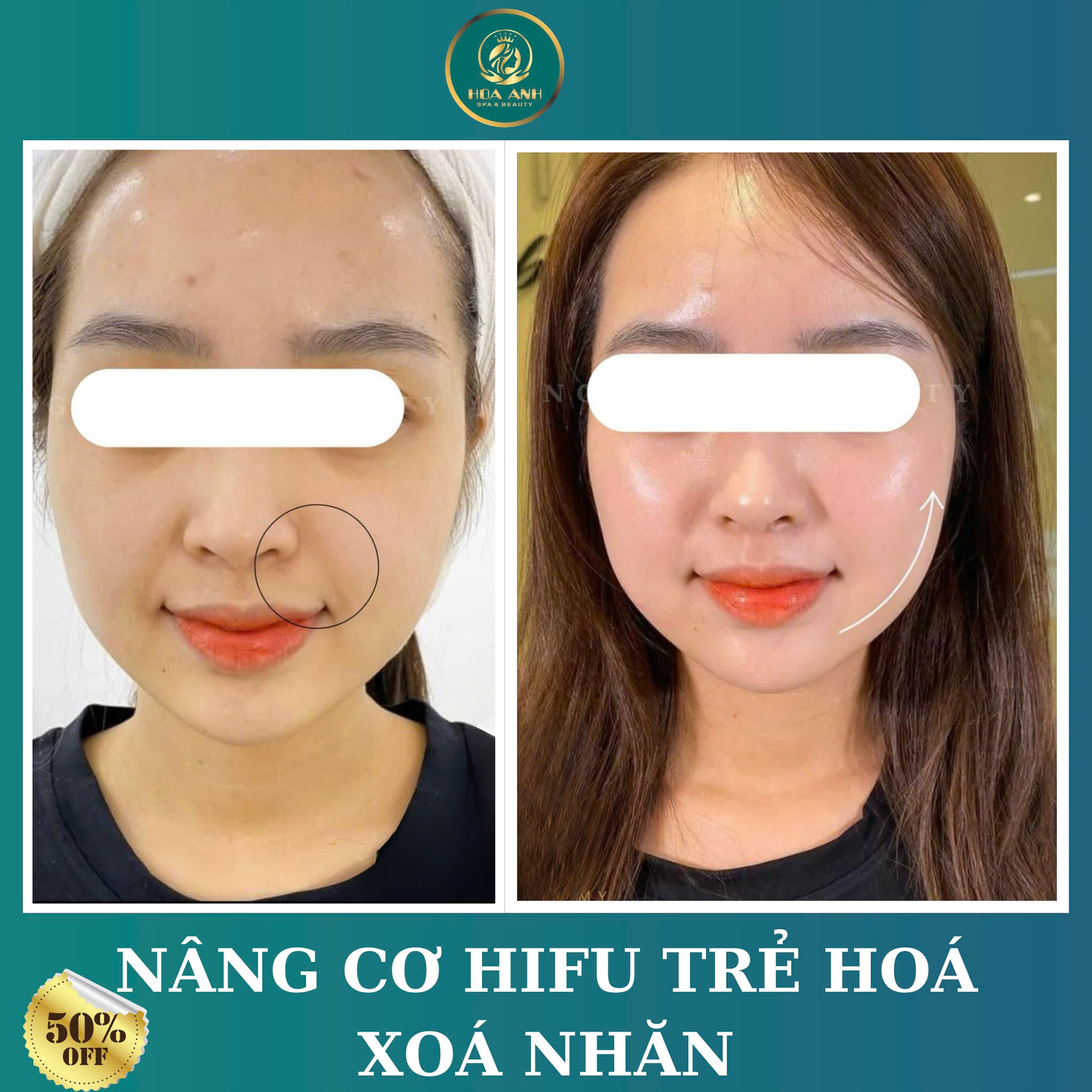 NÂNG CƠ TRẺ HOA DA