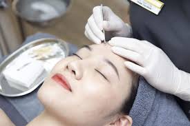 ĐIỀU TRỊ MỤN CHUẨN Y KHOA