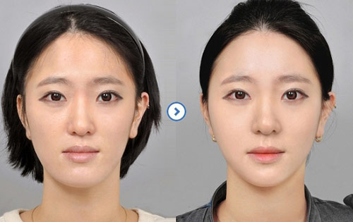 Chi phí tiêm tan mỡ mặt là bao nhiêu? Nó kéo dài bao lâu?