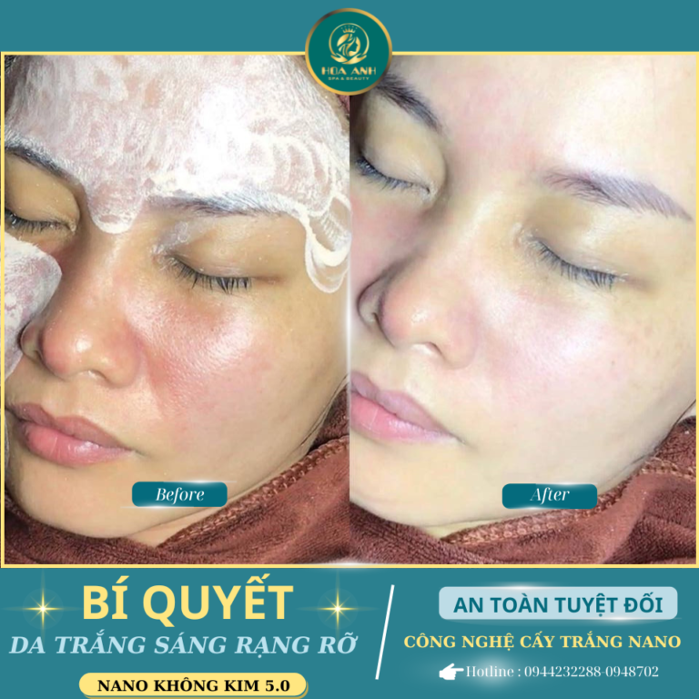 Cấy Trắng Nano Face Có Thực Sự An Toàn & Hiệu Quả? Khám Phá Tại Thẩm Mỹ Viện Hoa Anh