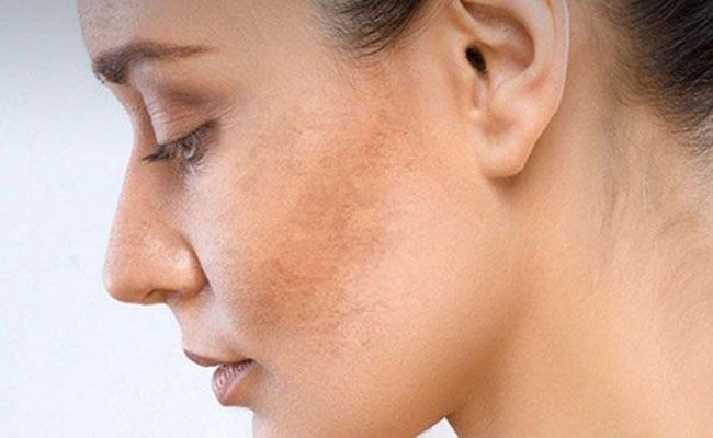 Cách tạm biệt làn da sạm xỉn màu
