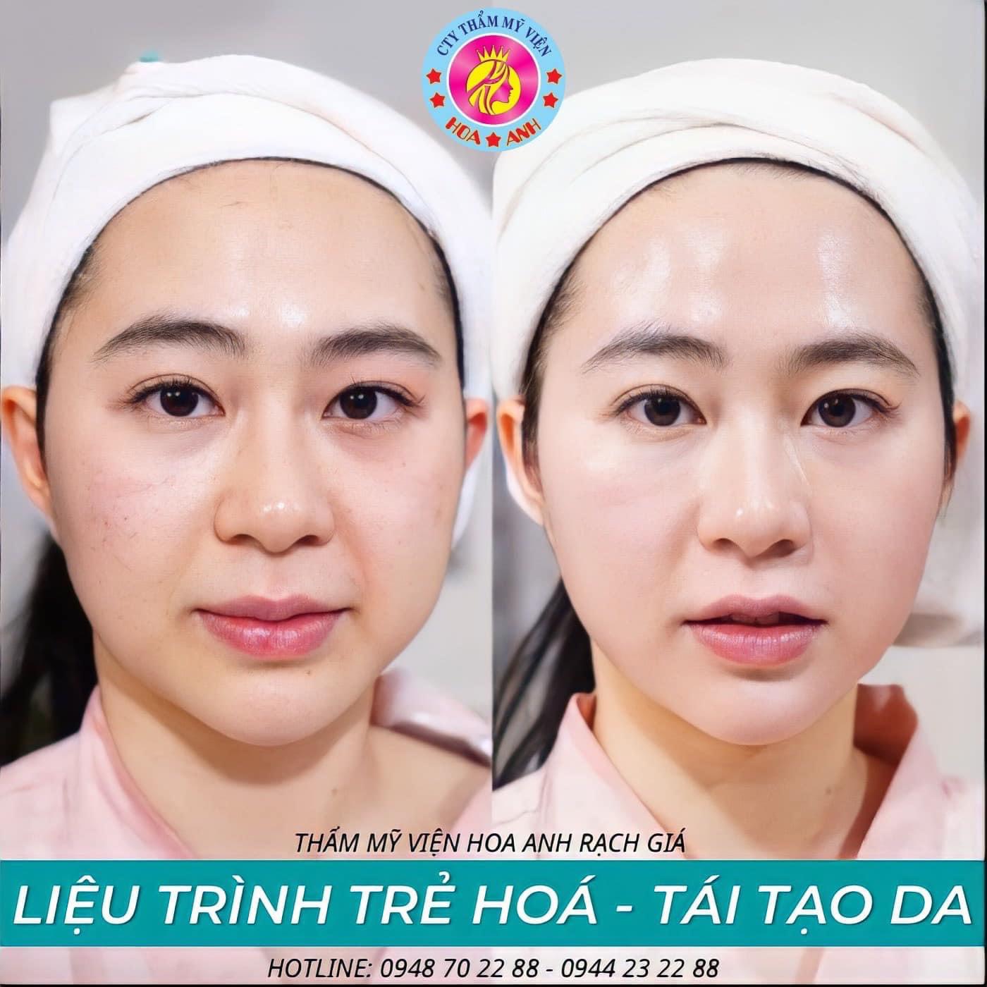Đánh Bay Nám Sạm Nhờ Phương Pháp Thay Da Kim Cương Tại Thẩm Mỹ Viện Hoa Anh