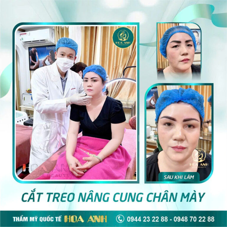 Treo Cung Chân Mày – Bí Quyết Trẻ Hóa Đôi Mắt Tức Thì Tại Thẩm Mỹ Viện Hoa Anh