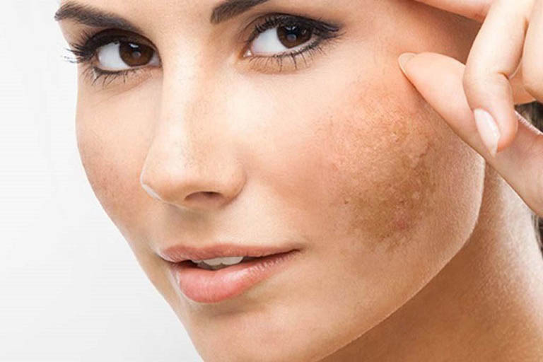 Nám mảng là gì?