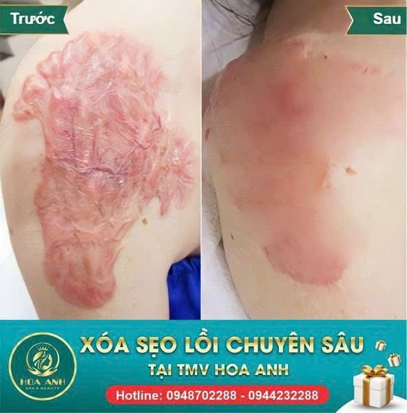 Điều Trị Sẹo Lồi Có Hết Không? Có Đau Không? Chuyên Gia Thẩm Mỹ Viện Hoa Anh – An Giang Giải Đáp Chi Tiết