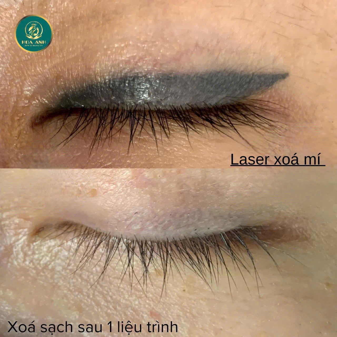 Xóa mí có nguy hiểm cho mắt không? Chia sẻ chân thật từ Thẩm mỹ viện Hoa Anh
