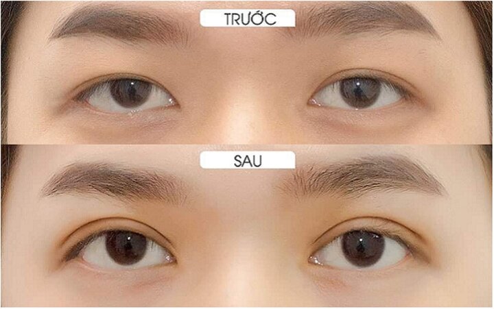 Mắt bị cận có nên cắt mí không?