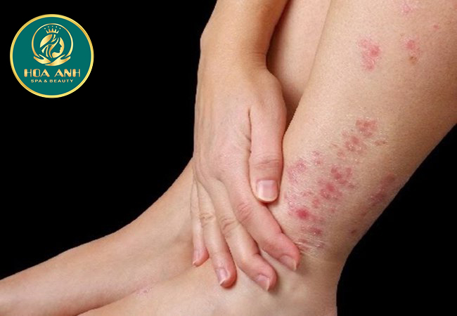 Cách dùng thuốc điều trị bệnh chàm