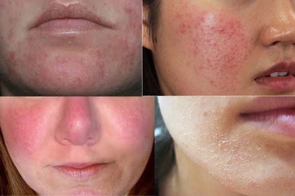 Điều Trị Da Sau Khi Peel Da Hỏng Tại Thẩm Mỹ Viện Hoa Anh