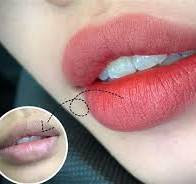 XỬ LÝ THÂM MÔI ĐÚNG KĨ THUẬT