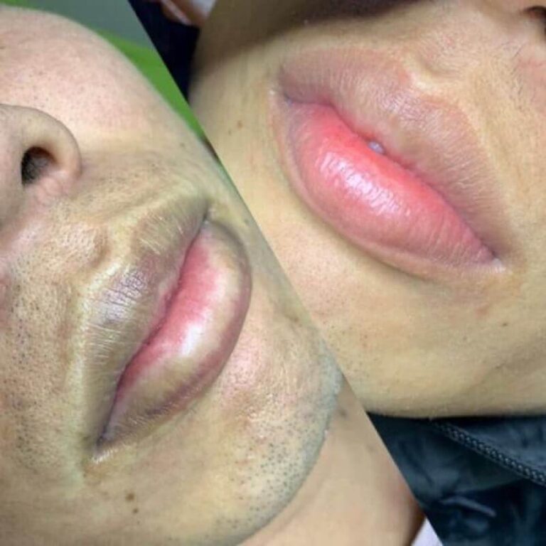 Dịch Vụ Khử Thâm Môi Cho Nam Tại Thẩm Mỹ Viện Hoa Anh – Giải Pháp Cho Đôi Môi Hồng Hào, Tự Nhiên