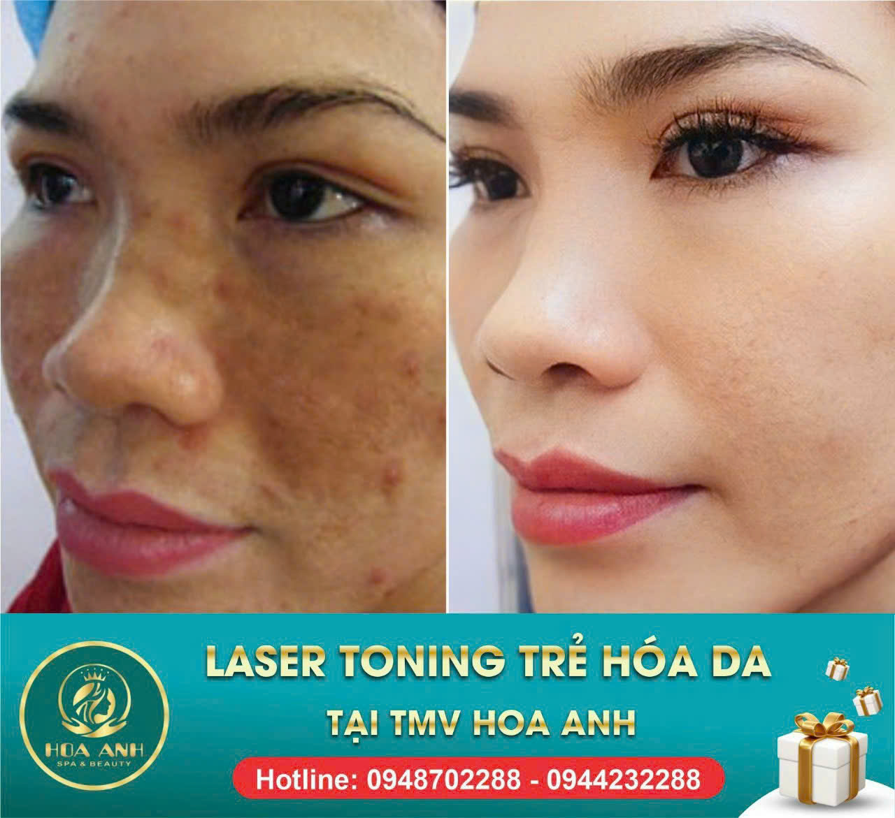 Xóa Tàn Nhang, Nám Đón Tết – Làn Da Rạng Rỡ Đón Xuân Cùng Hoa Anh