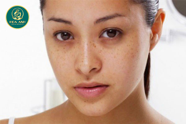 Các cách trị thâm mắt hiệu quả