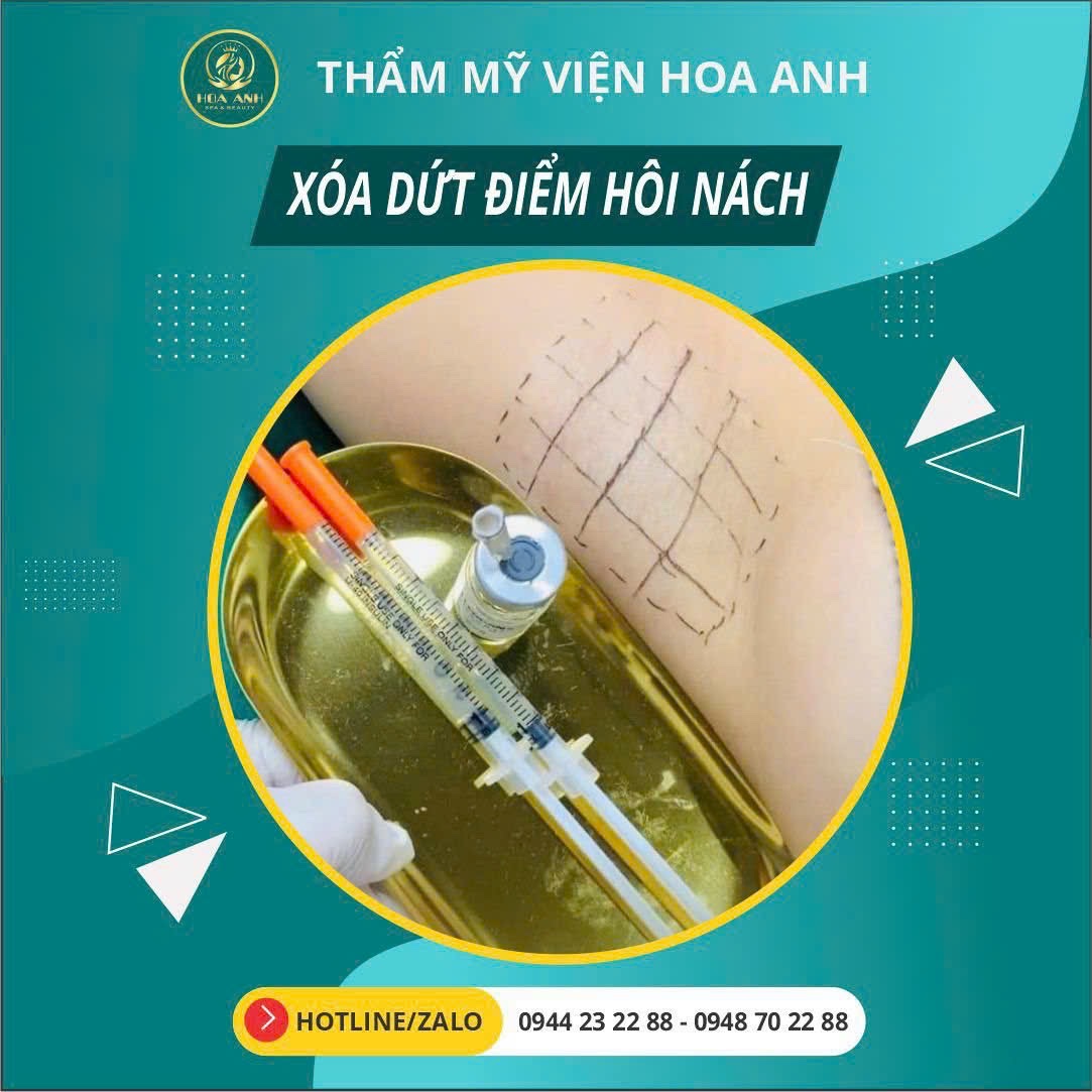 Tiêm Tuyến Mồ Hôi Nách Có Thật Sự Hết Không? Góc Nhìn Thực Tế Từ Thẩm Mỹ Viện Hoa Anh