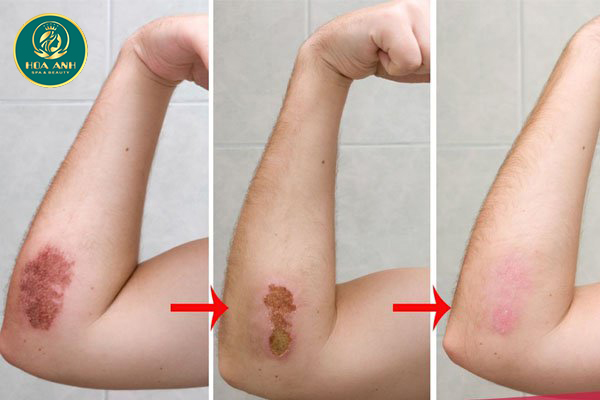 Khi nào thì dùng thuốc chống sẹo?