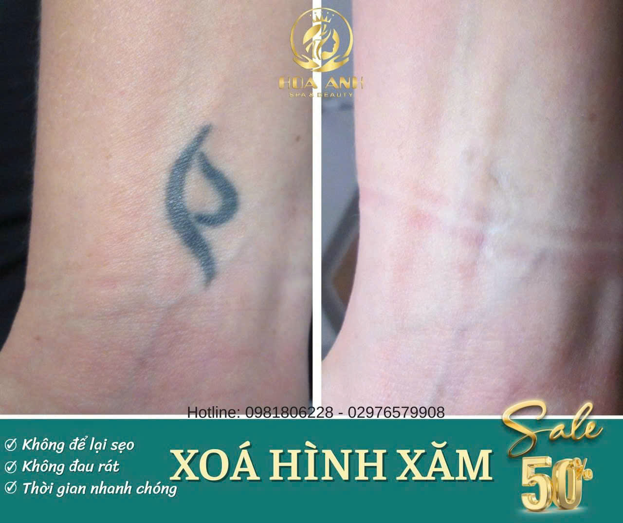 Xóa Xăm An Toàn – Công Nghệ Xóa Xăm Helios 3 , Không Sẹo Tại Thẩm Mỹ Viện Hoa Anh