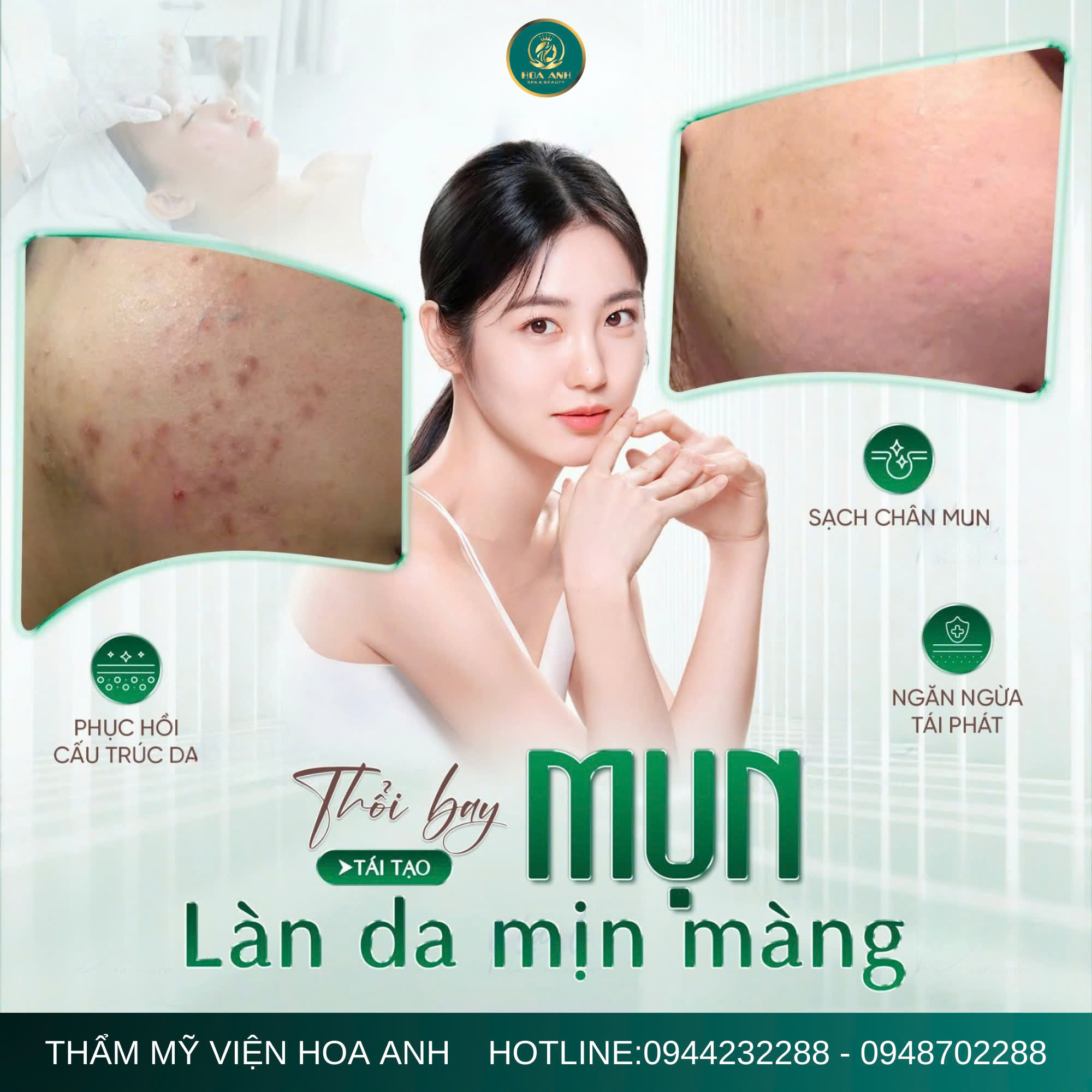 Chăm Sóc Da Tại Nhà Sau Khi Điều Trị Mụn – Bí Quyết Giúp Da Nhanh Lành, Ngừa Thâm Sẹo Hiệu Quả