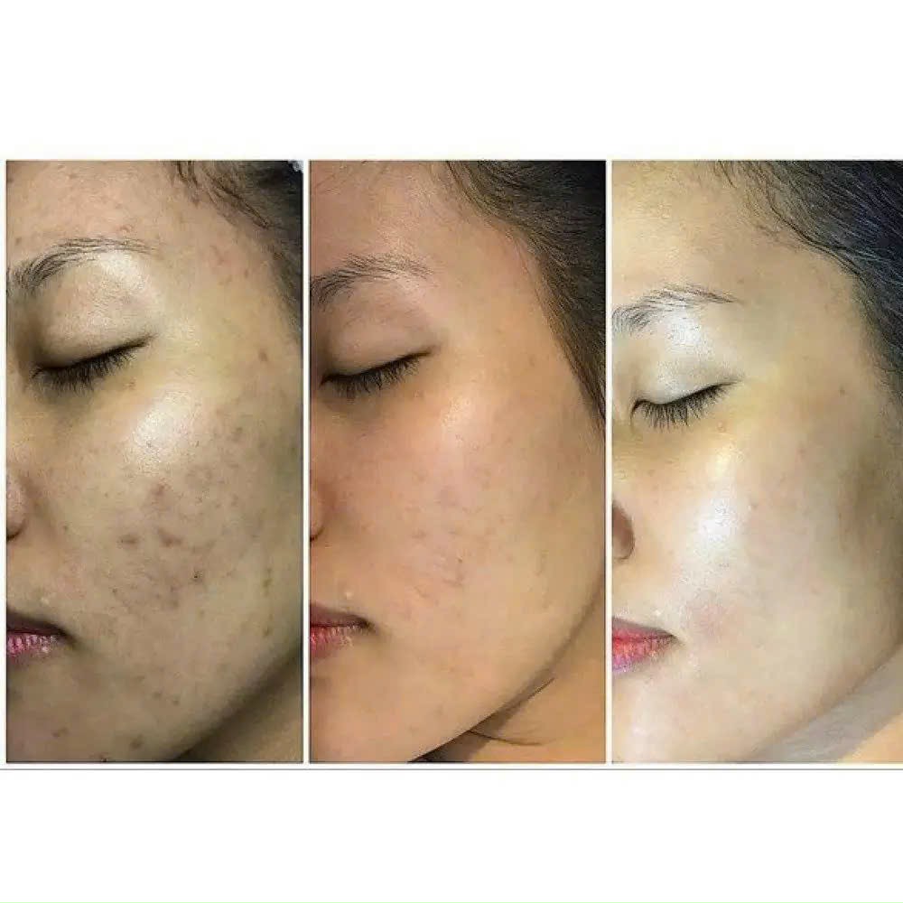 TÁI SINH DA VI ĐIỂM