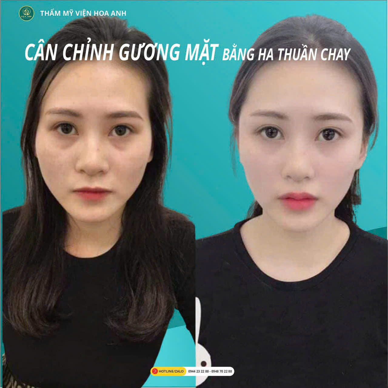 Tiêm Filler Cân Chỉnh Gương Mặt Tỉ Lệ Vàng – Bí Quyết Sắc Đẹp Hoàn Hảo Tại Thẩm Mỹ Viện Hoa Anh