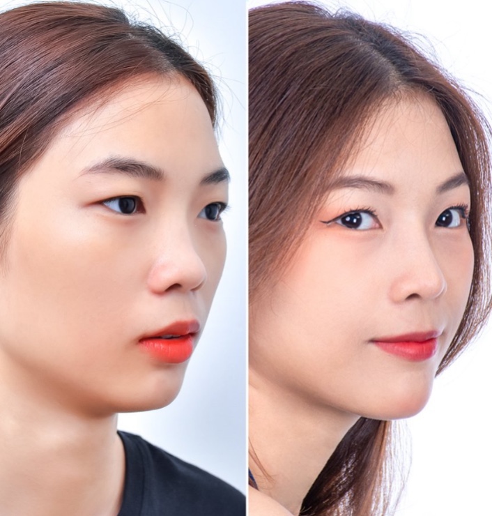 Nâng mũi bằng chỉ collagen là gì?